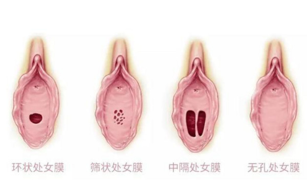 處女膜.jpg 處女膜.jpg